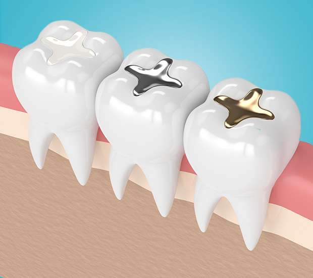 Sherman Oaks Composite Fillings