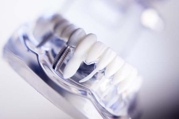 Reasons To Choose Dental Implants For Missing Tooth Replacement