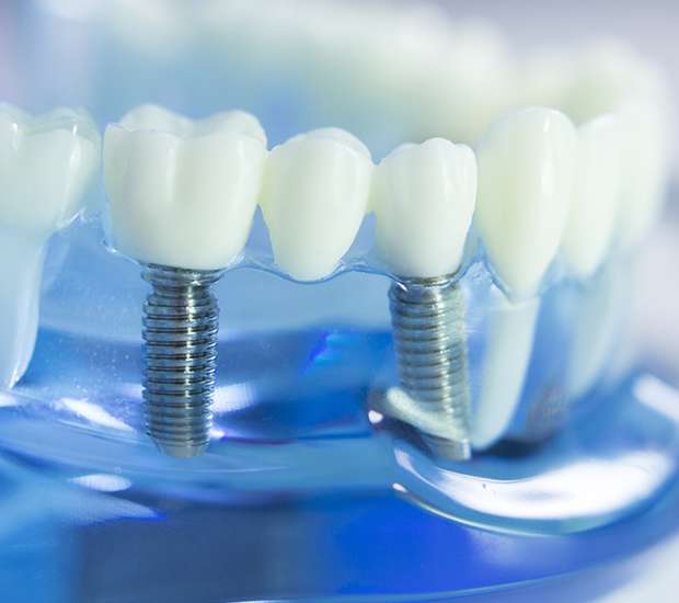 Sherman Oaks Dental Implants