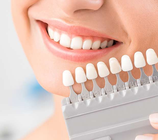 Sherman Oaks Dental Veneers and Dental Laminates