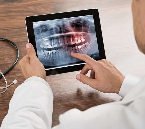 Sherman Oaks Types of Dental Root Fractures